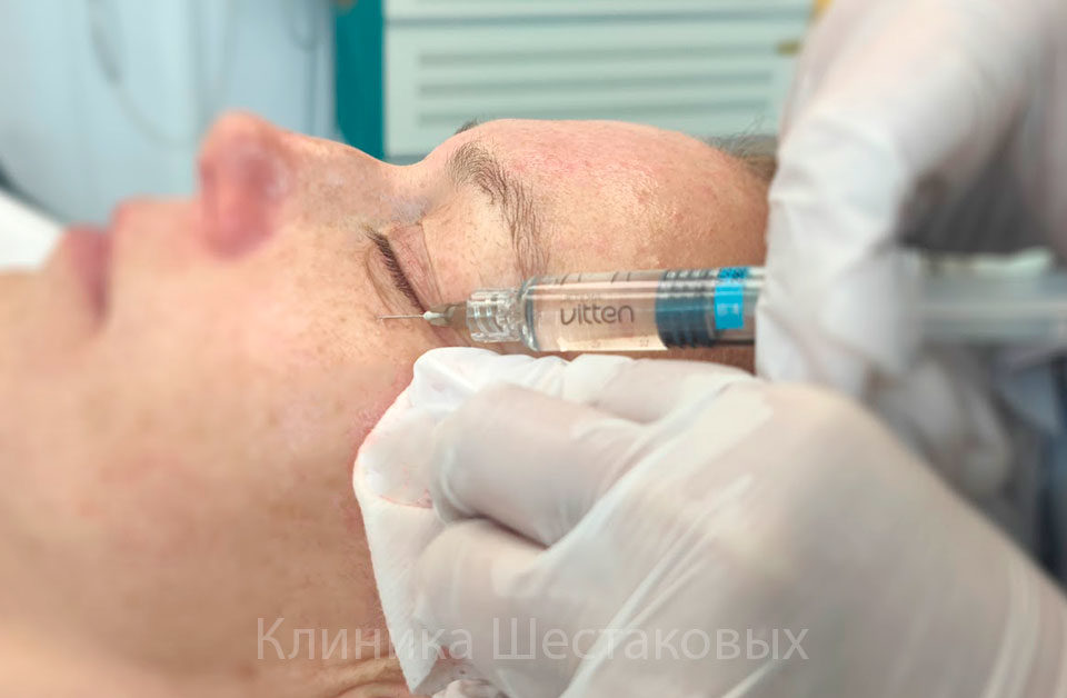 Биоревитализация для омоложения