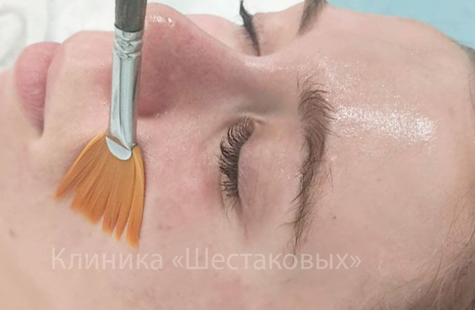 Салициловый пилинг