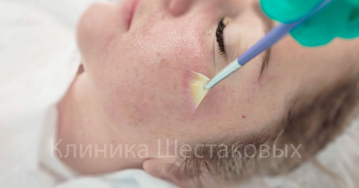Как вылечить розацеа отзывы