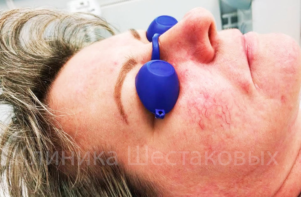 Розацеа в домашних условиях