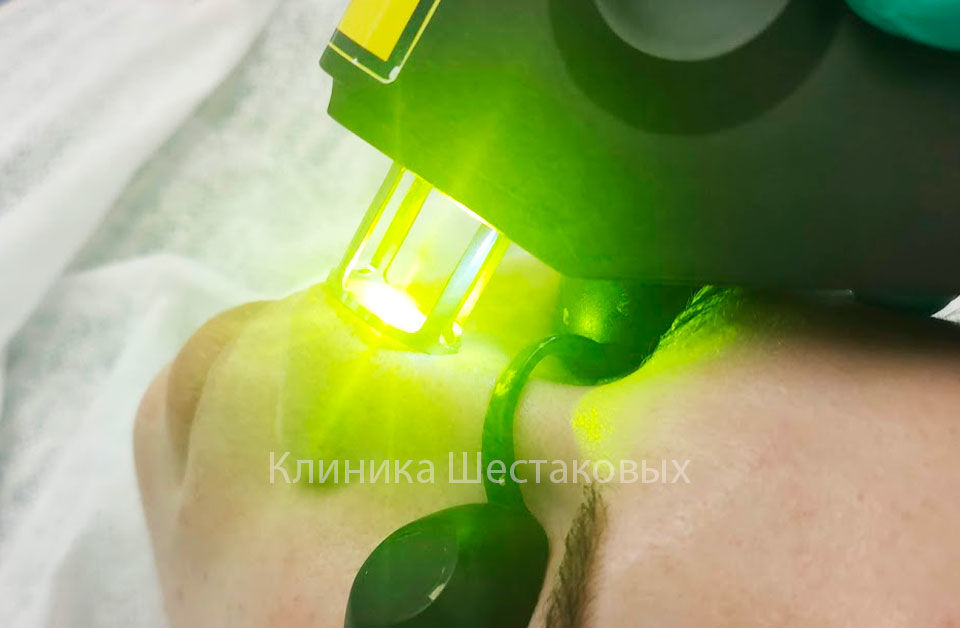 Процедура анти акне