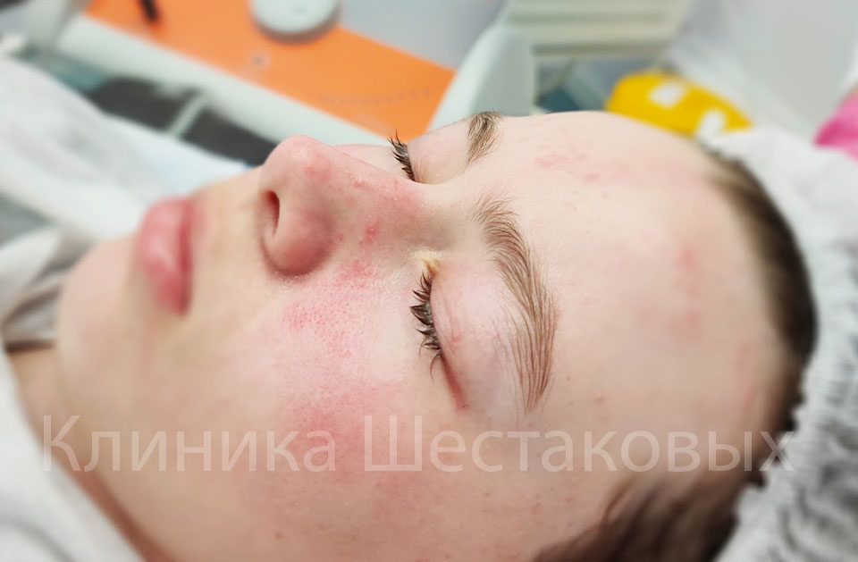 Прыщики акне
