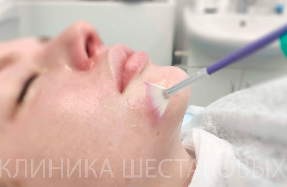Азелаиновый пилинг для лица