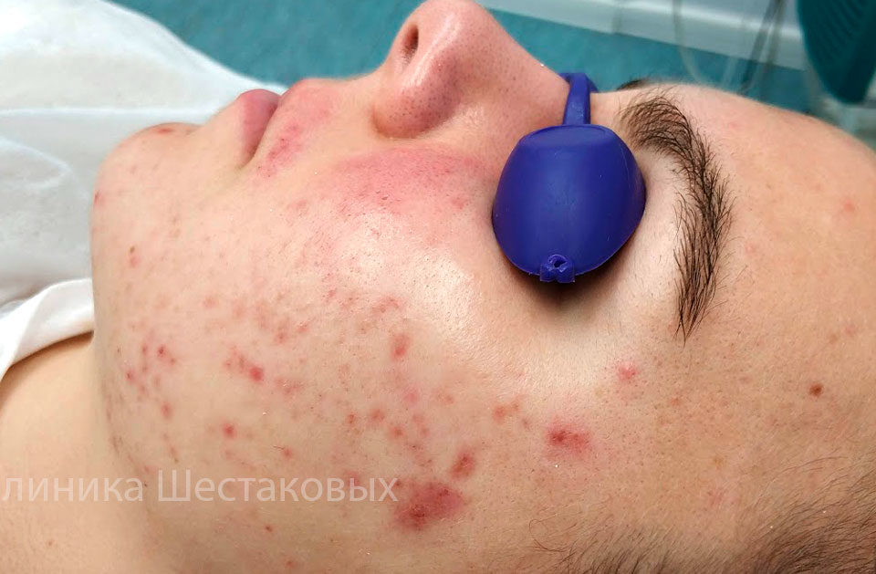 Причины акне на лице