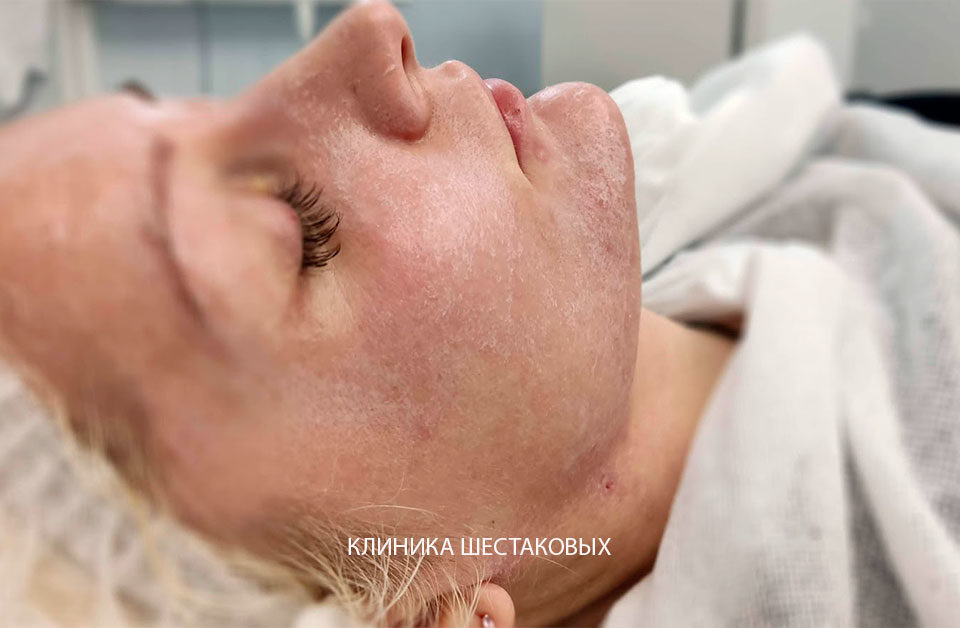Зачем делать пилинг лица