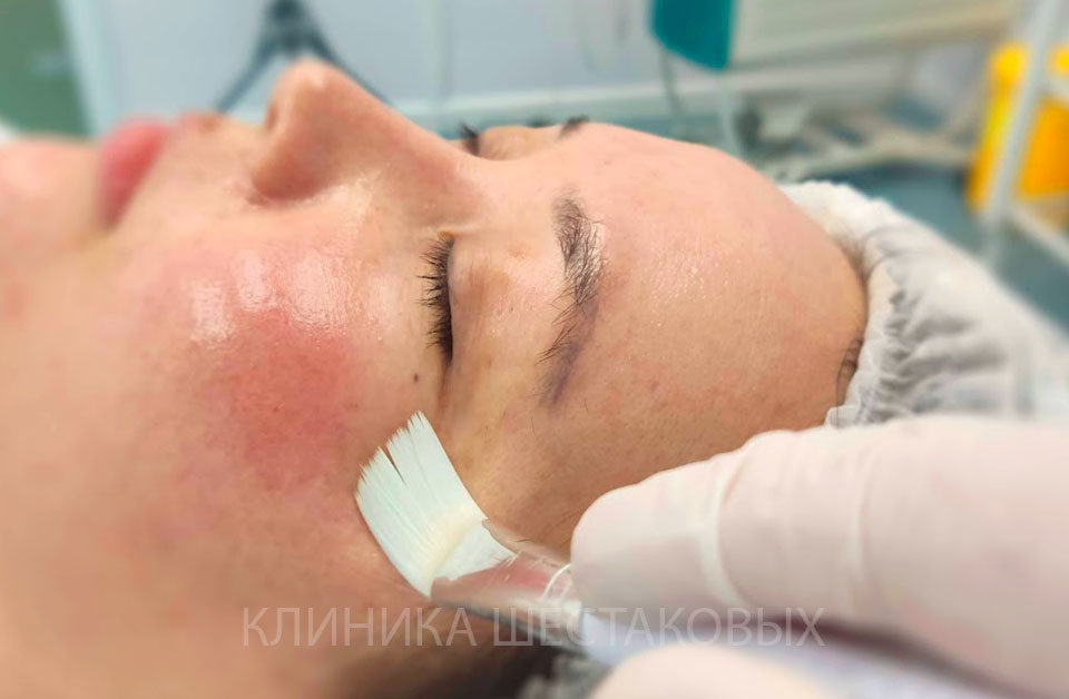 Красные пятна после пилинга