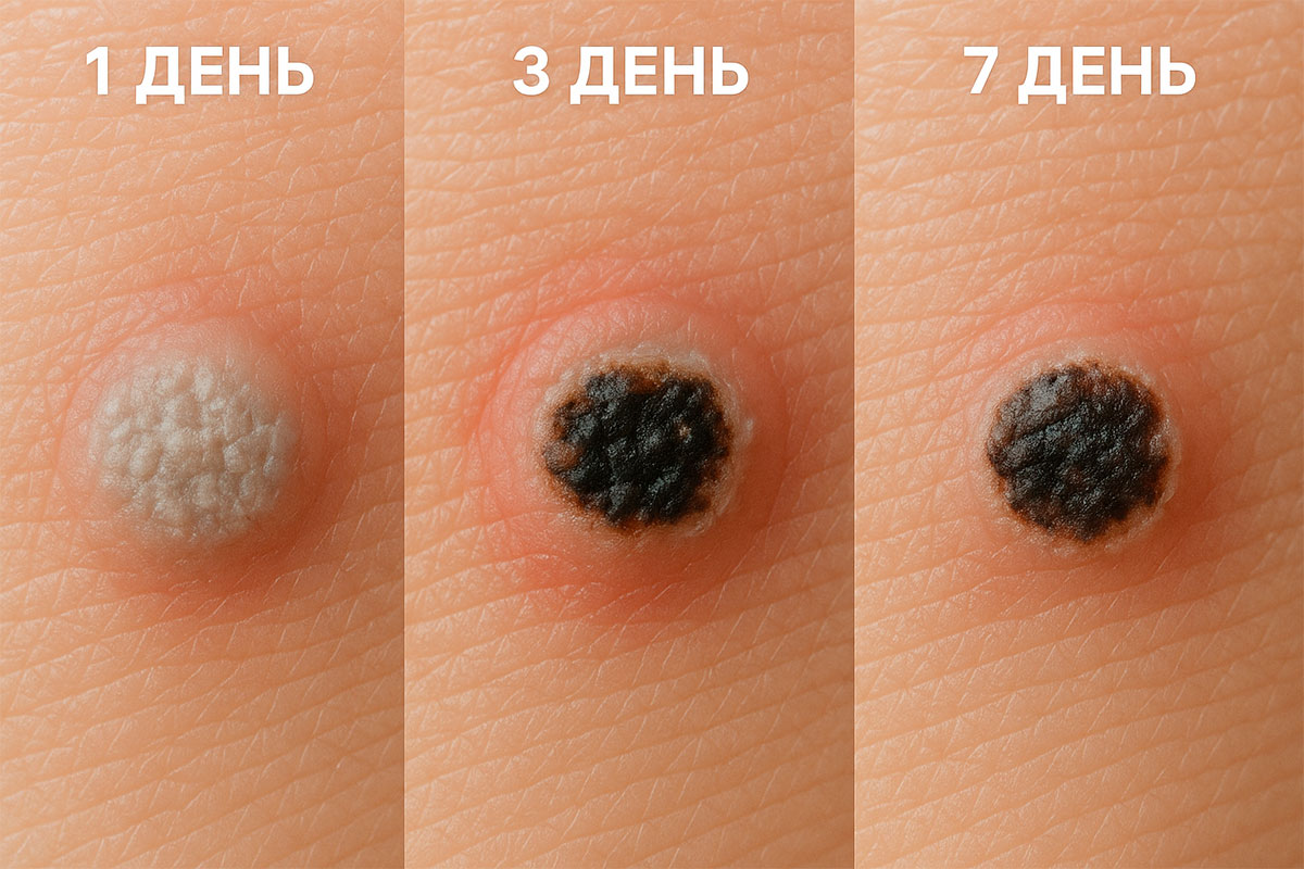 Бородавка после азота
