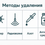 Эффективный способ удаления бородавок