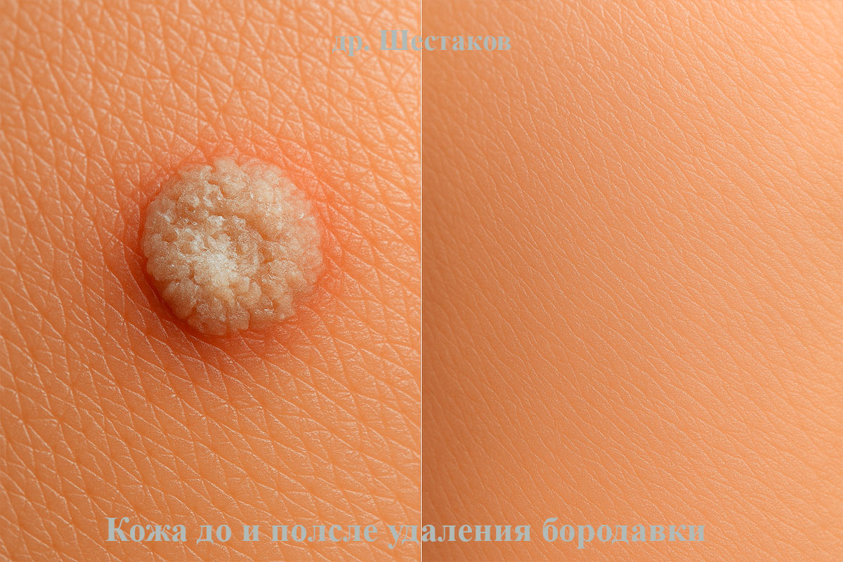 Эффективный способ удаления бородавок