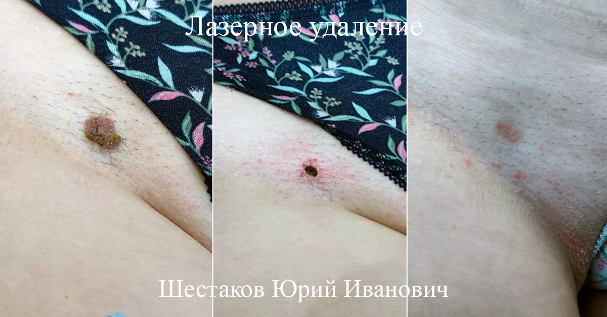 Лазерное удаление