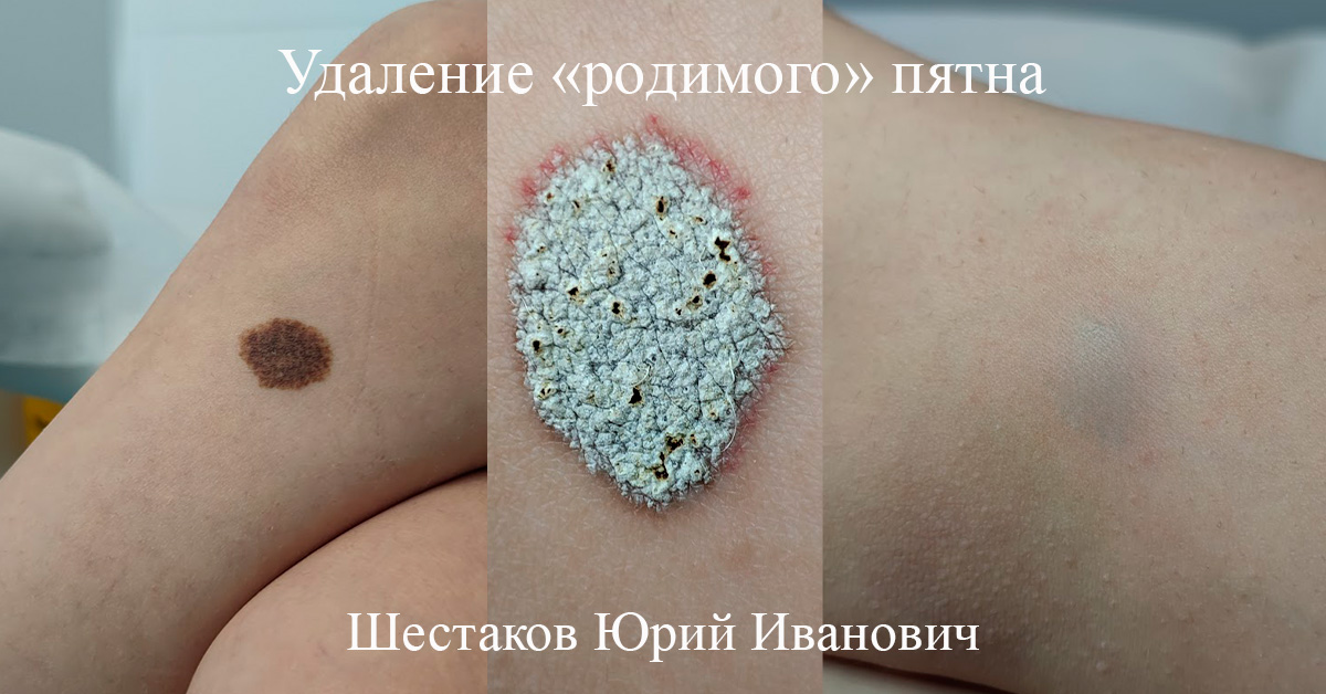 Родимые пятна фото