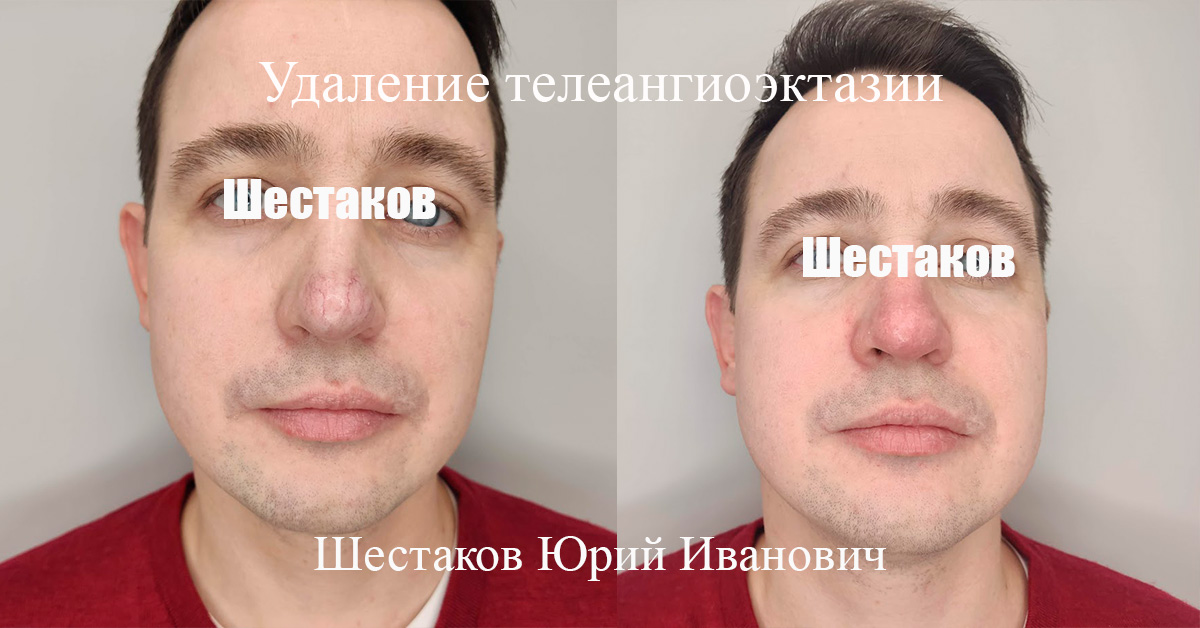 Телеангиоэктазия фото
