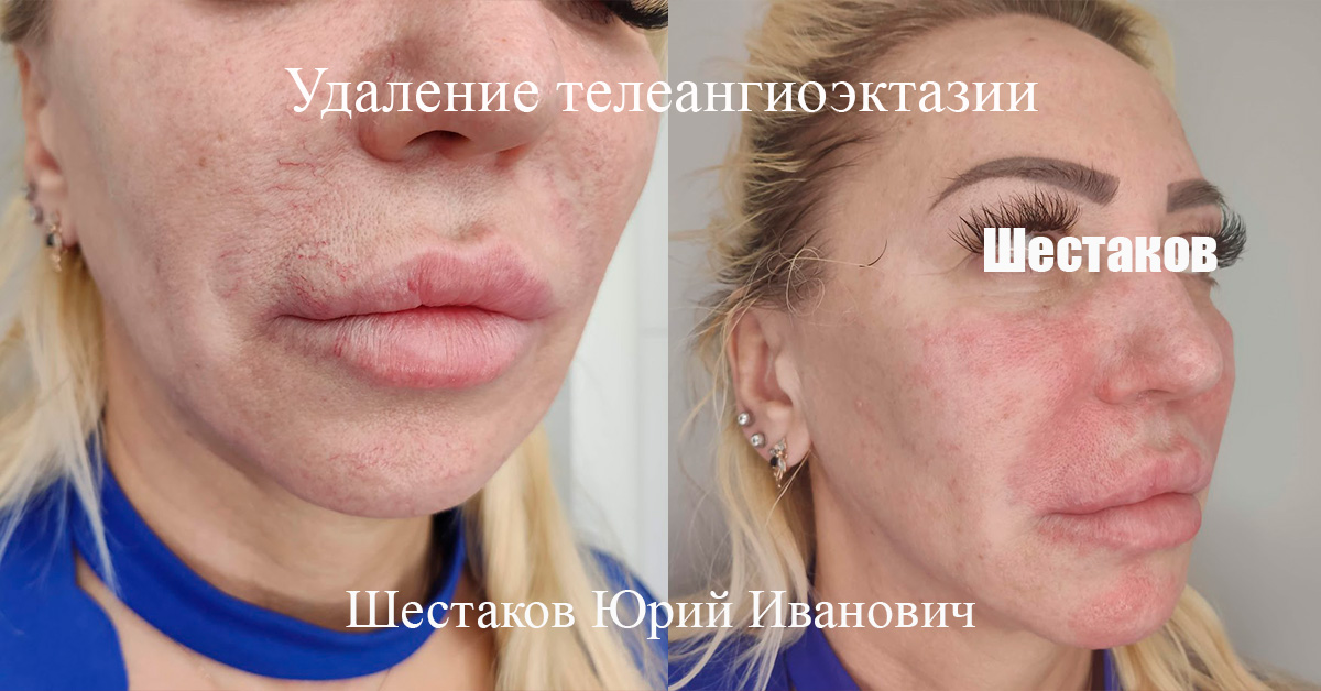 Телеангиоэктазия фото