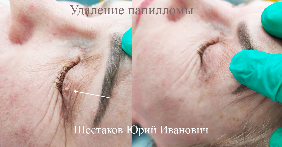 Удаление папилломы