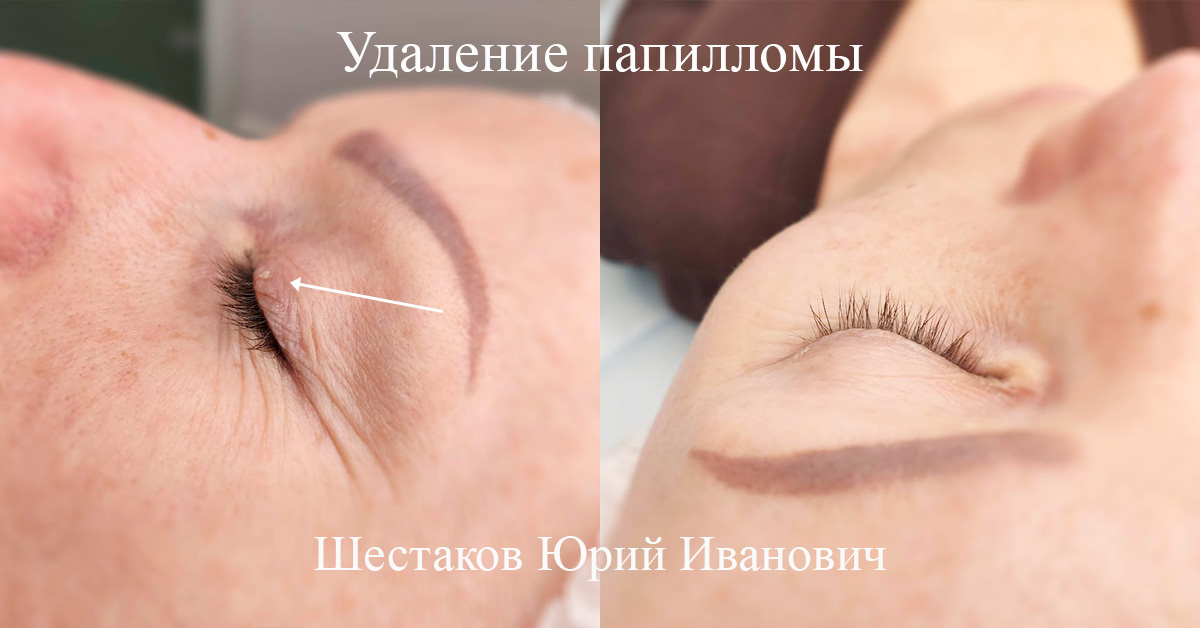 Удаление папилломы