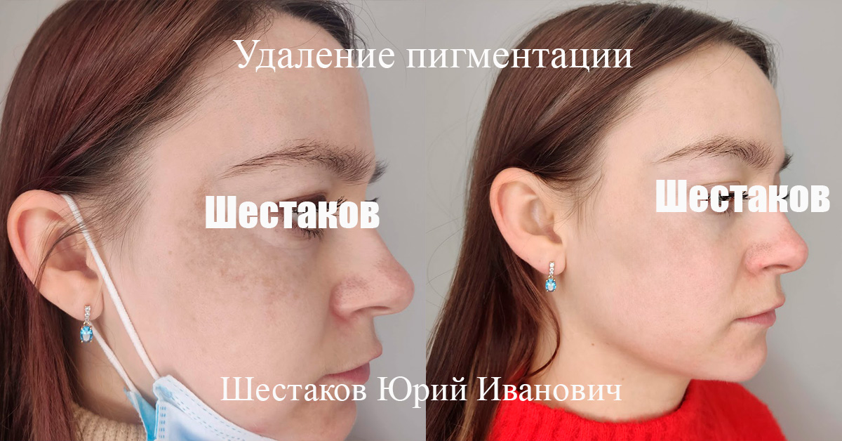 Удаление пигментации
