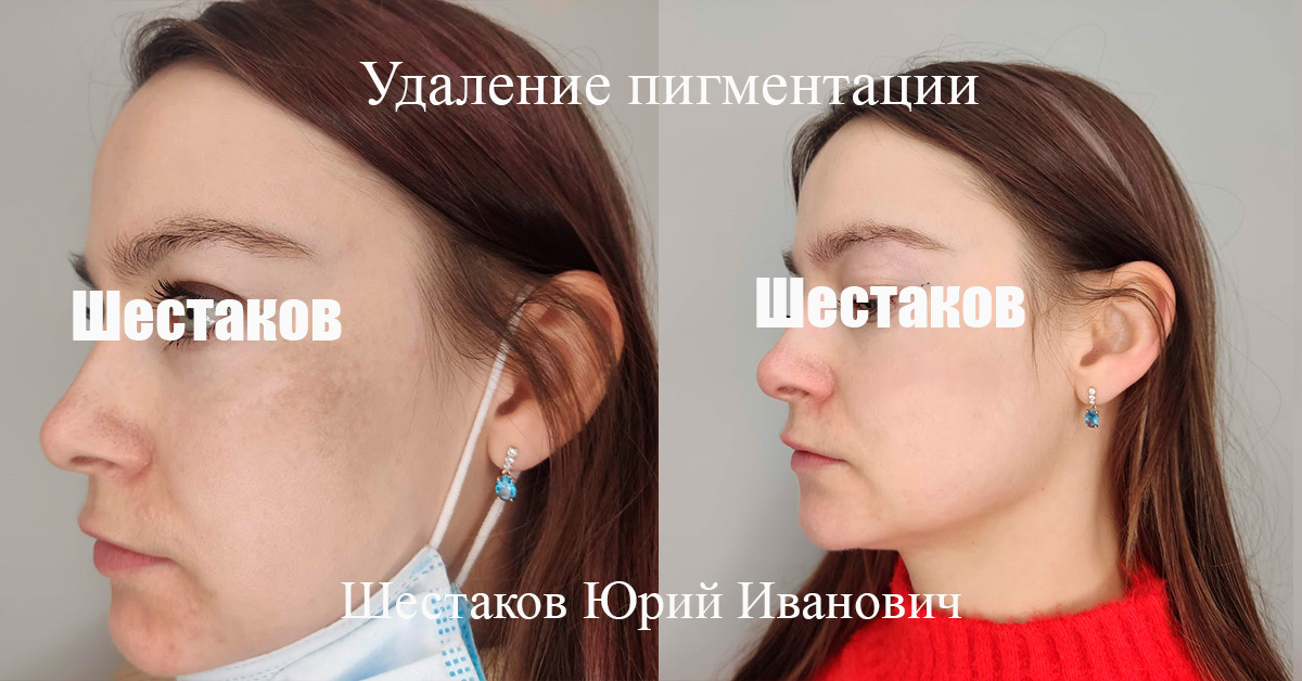 Удаление пигментации