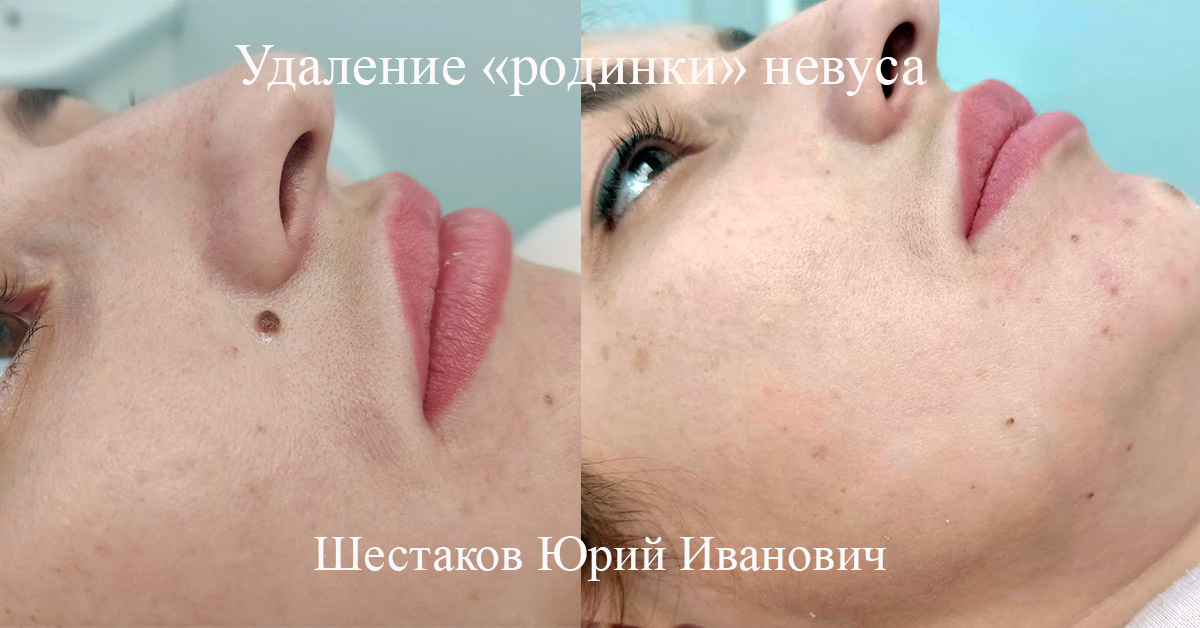 Удаление «родинки» невуса