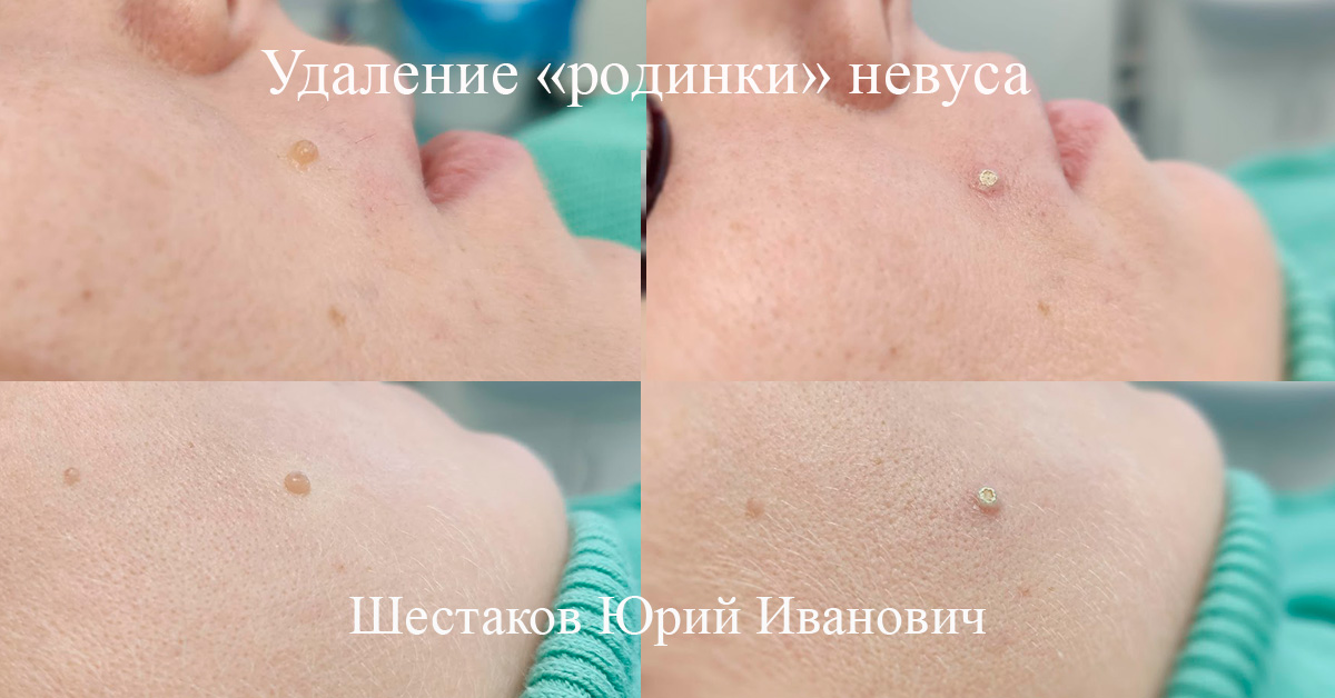 Удаление «родинки» невуса