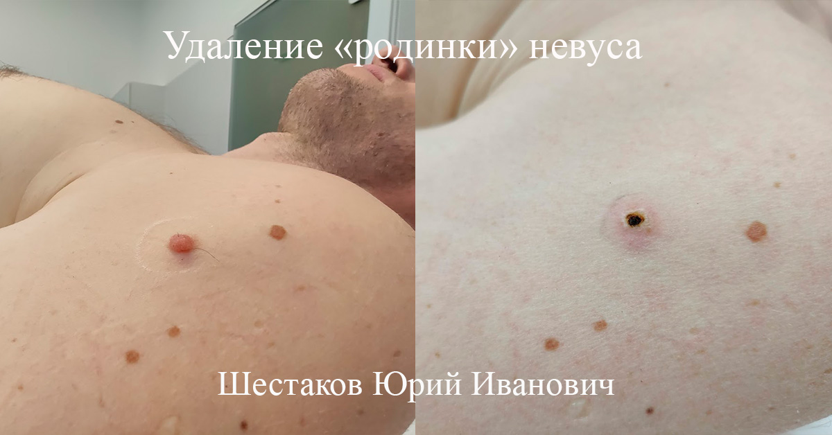 Удаление «родинки» невуса