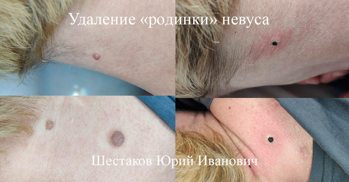Удаление «родинки» невуса