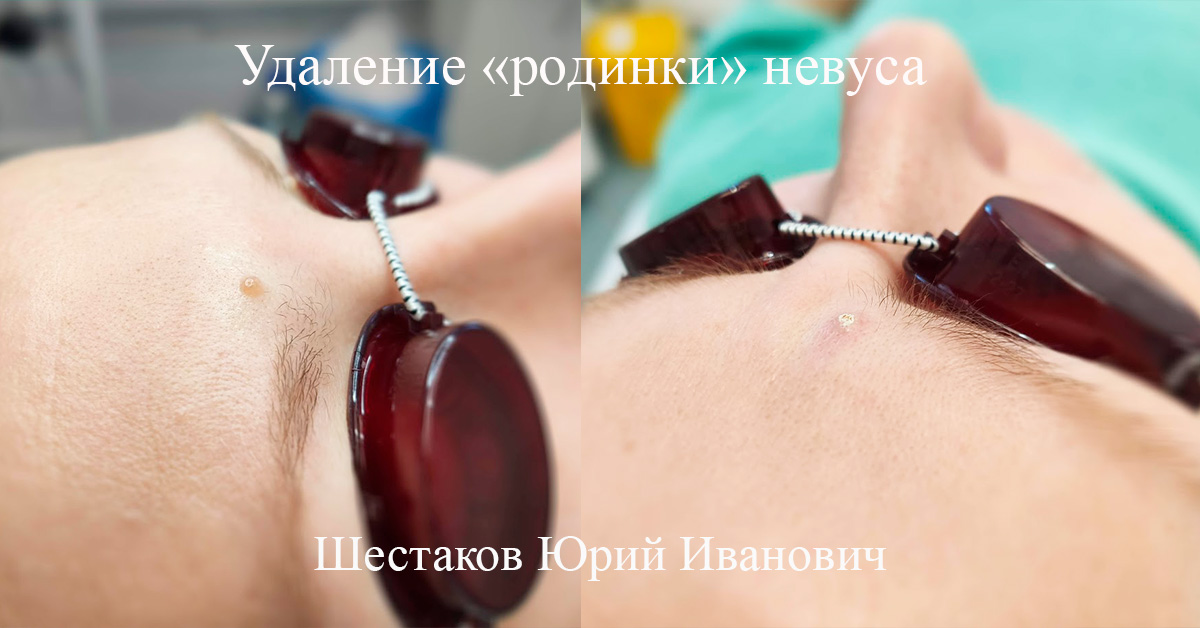 Удаление «родинки» невуса