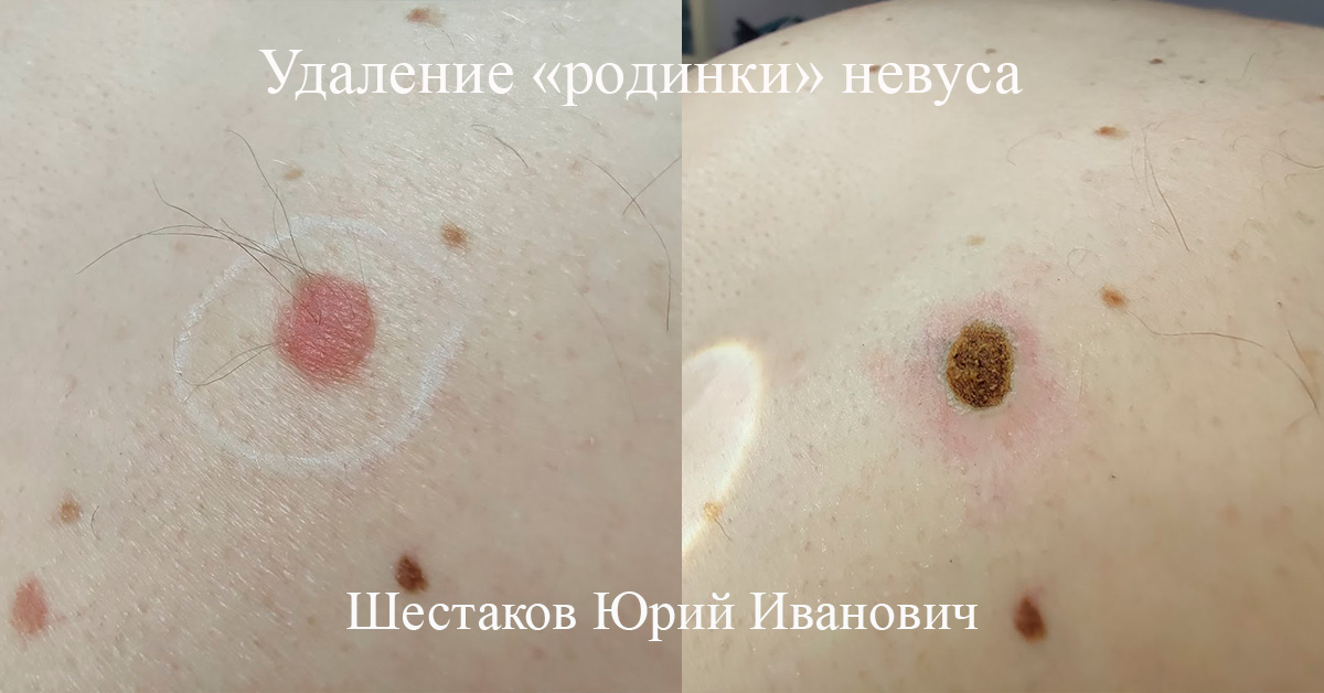Удаление «родинки» невуса