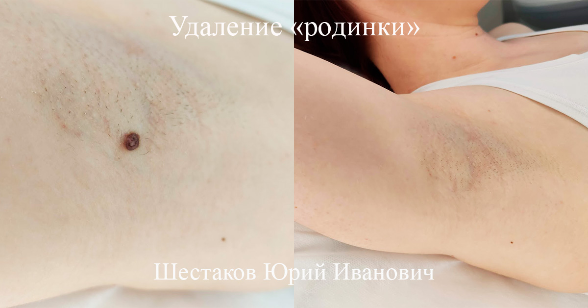Удаление «родинки»