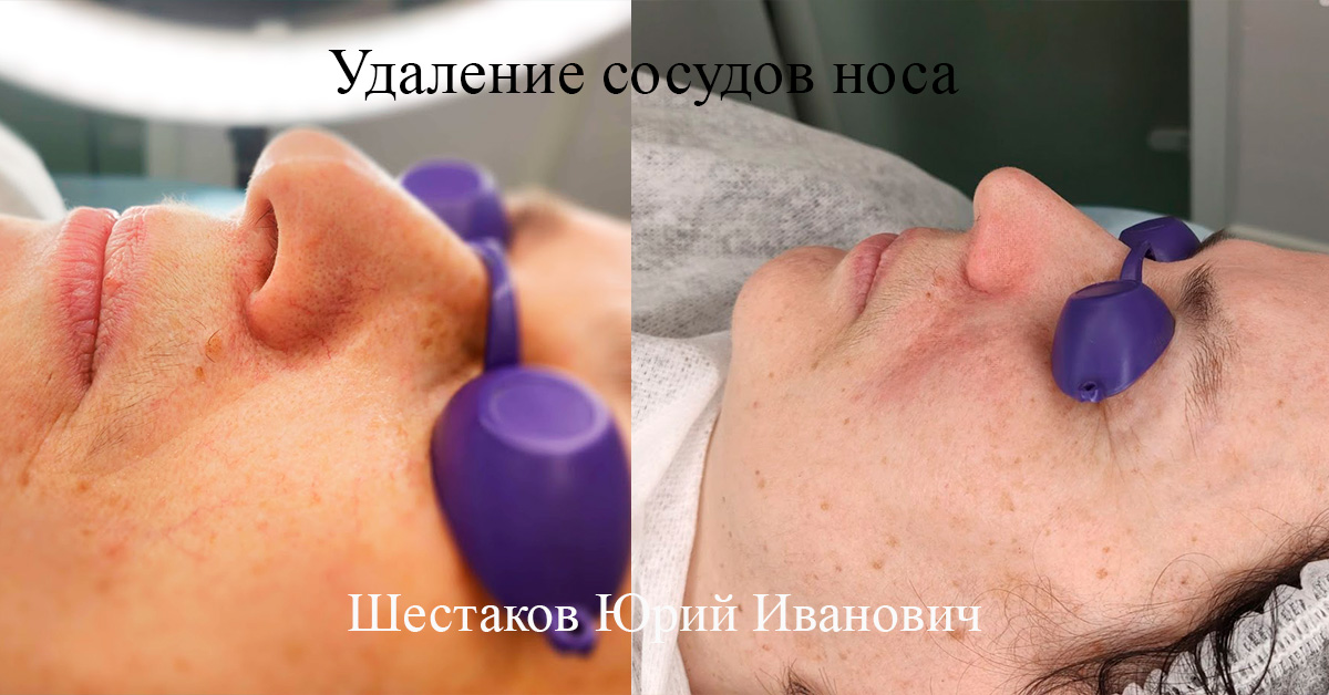 Удаление сосудов носа