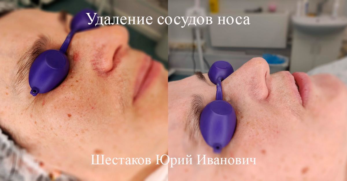 Удаление сосудов носа фото