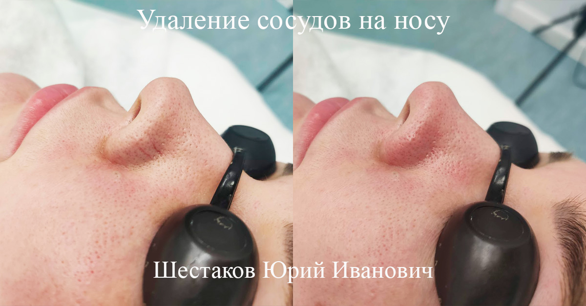 Удаление сосудов
