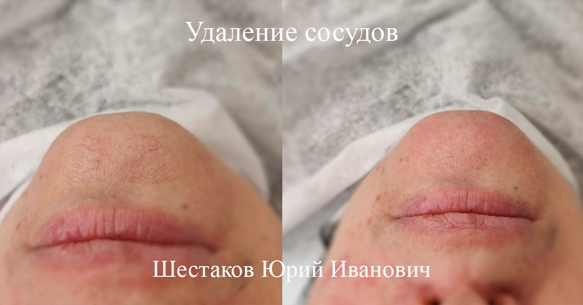Удаление сосудов фото
