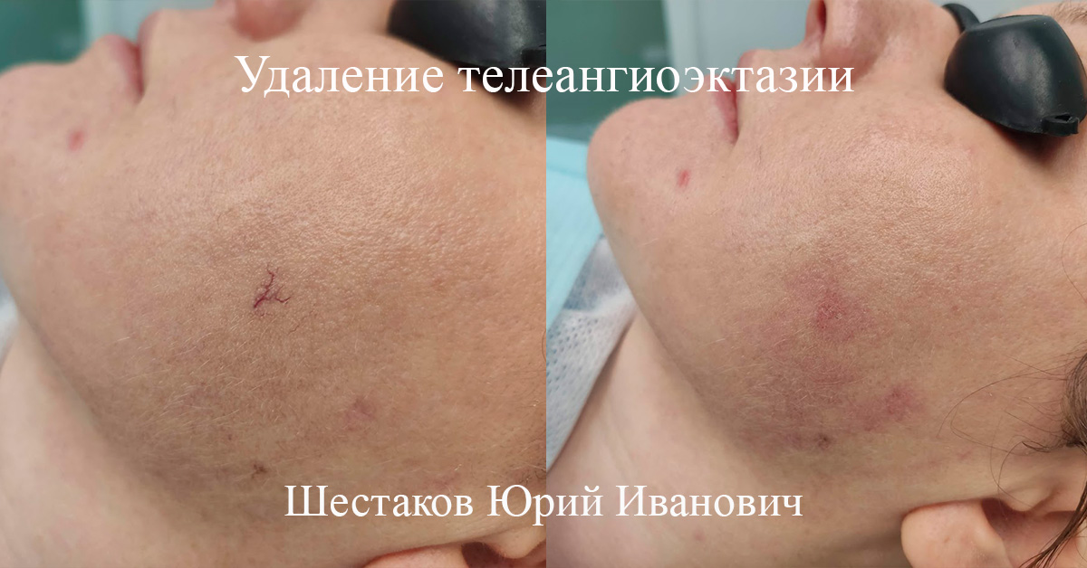Удаление телеангиоэктазии