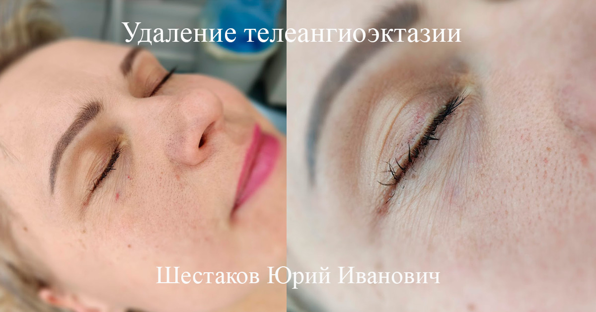 Удаление телеангиоэктазии