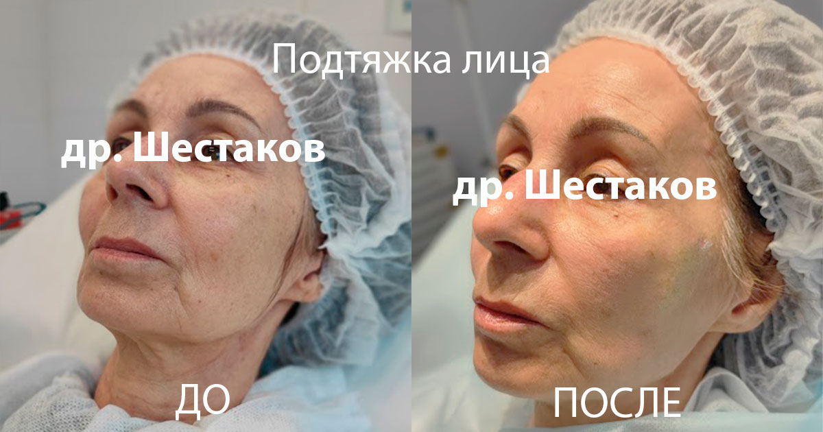 Подтяжка лица