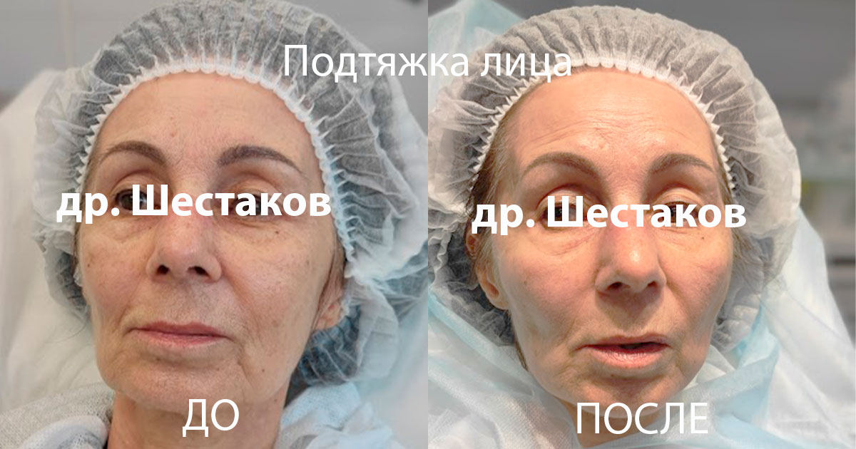 Подтяжка лица