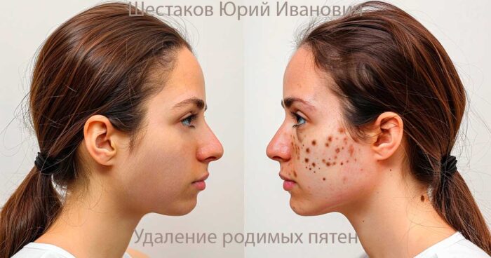 Удаление родимых пятен