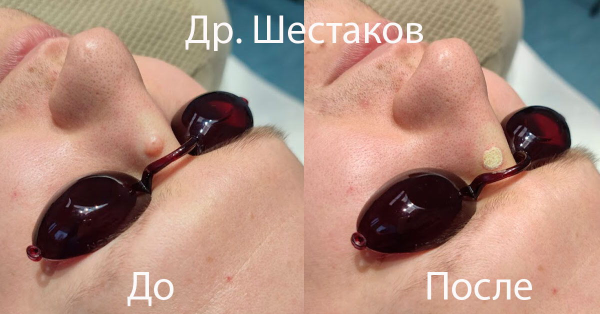 Бородавка после прижигания азотом фото