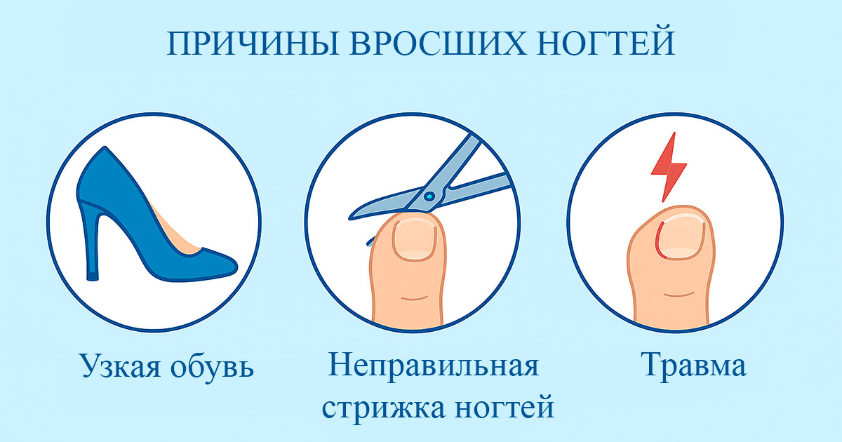 Как вылечить вросший ноготь