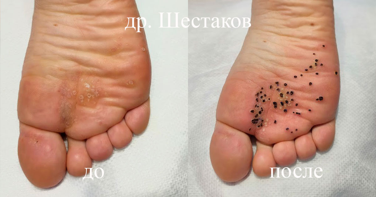 Подошвенная бородавка