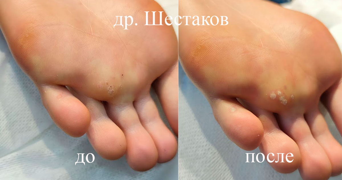 Подошвенная бородавка