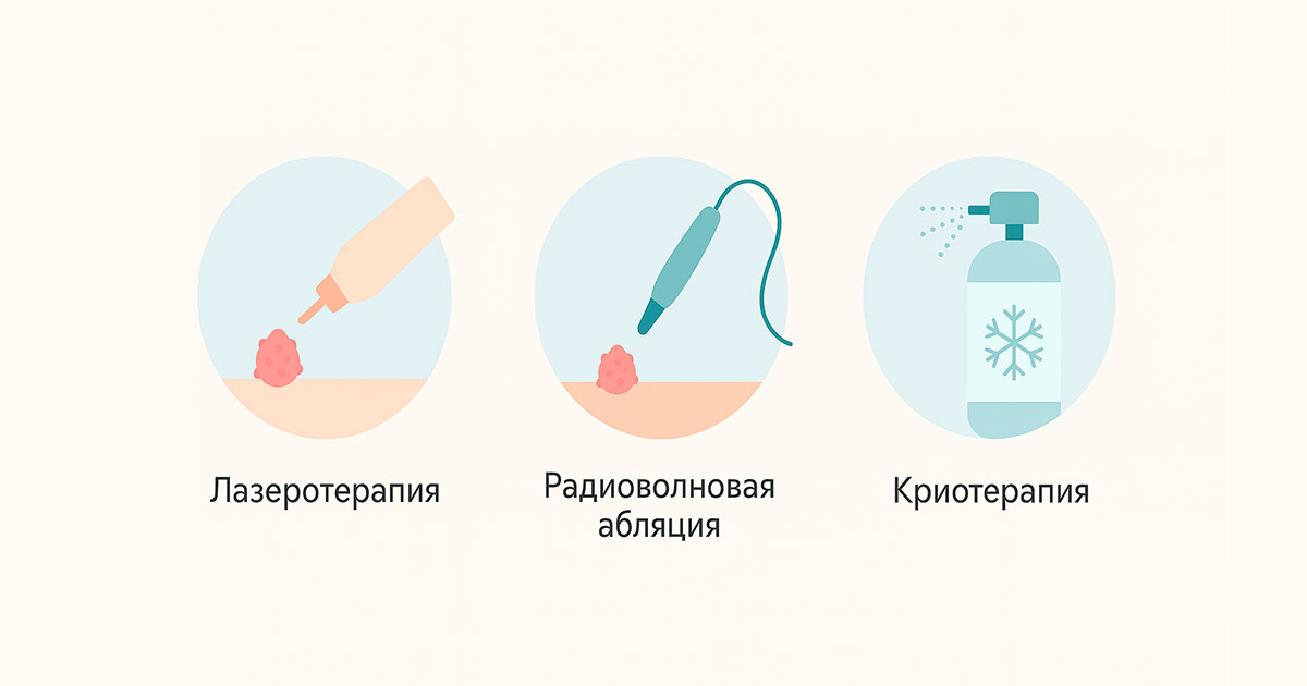 Удаление аногенитальных кондилом