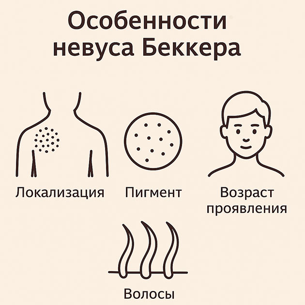Невус Беккера
