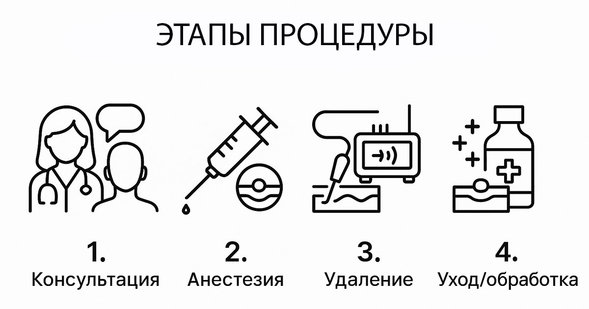 Радиоволновое удаление
