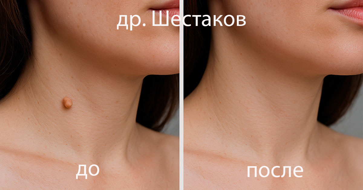 Вырезать папиллому