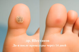 Бородавка на большом пальце ноги