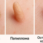Кондиломы и папилломы отличие