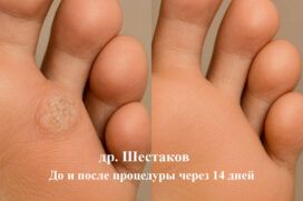 Межпальцевая бородавка на ноге