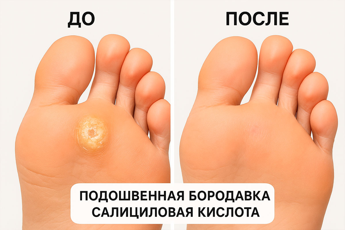Плоские бородавки лечение салициловой кислотой