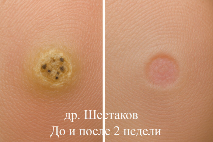 Прижигание азотом